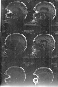 CT Scan - brain