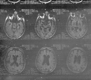 CT Scan - brain